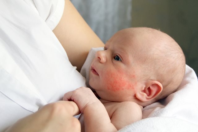 Trẻ em hay mắc các bệnh dị ứng nào?